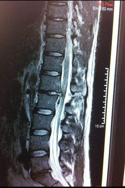 Back injury - kitesurfing  Kitesurfing Forums, page 1 - Seabreeze