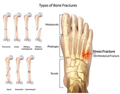 hairline fracture in foot symptoms